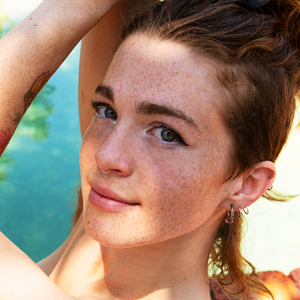 Freckles
